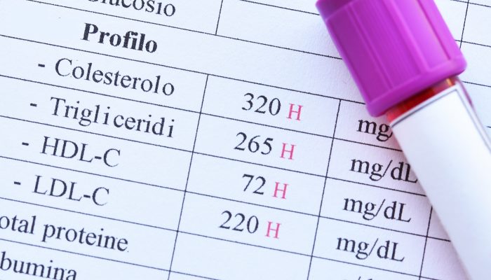 Abnormal high lipid test result with blood sample